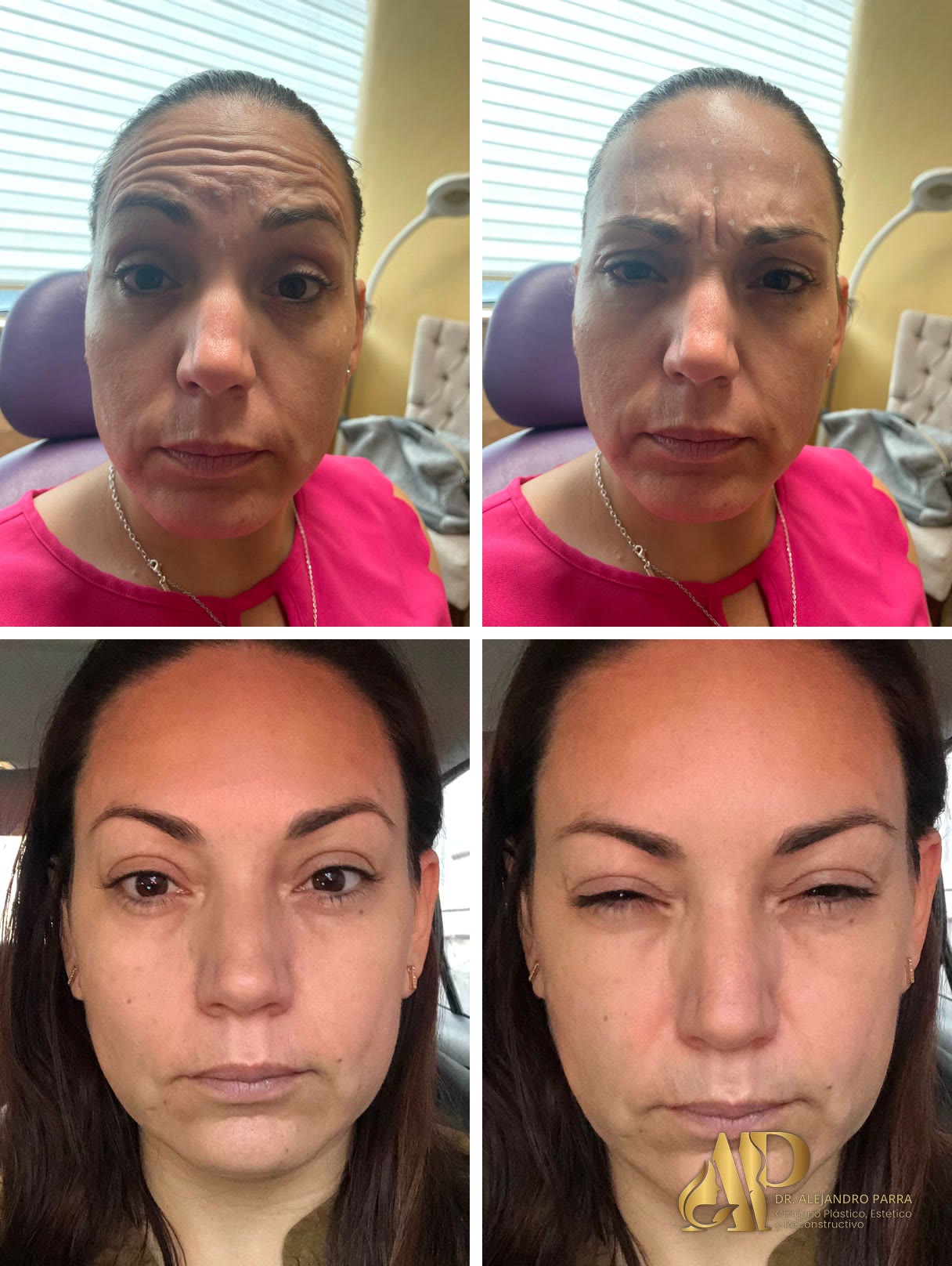 Antes y después de bótox. Arriba, antes: al levantar las cejas y al fruncir el ceño, con los puntos de aplicación marcados. Abajo, después: frente lisa en reposo y al gesticular