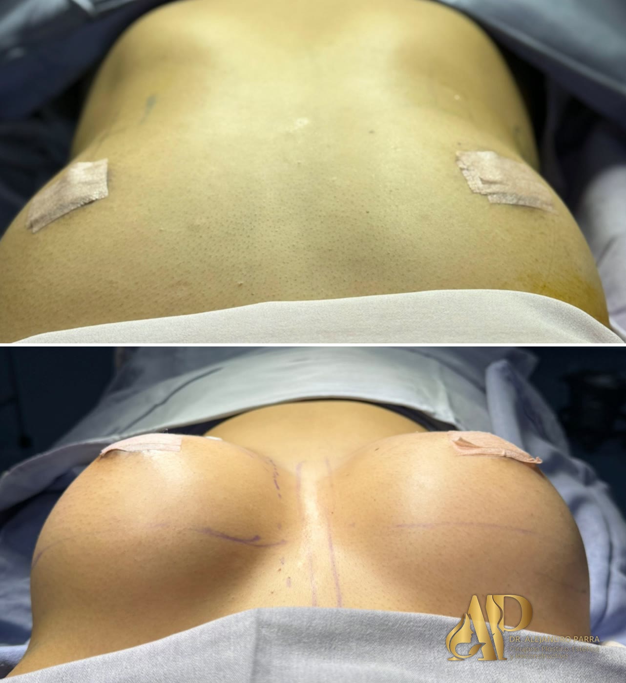 Antes y después de un aumento de mamas con implantes, fotografiado en quirófano