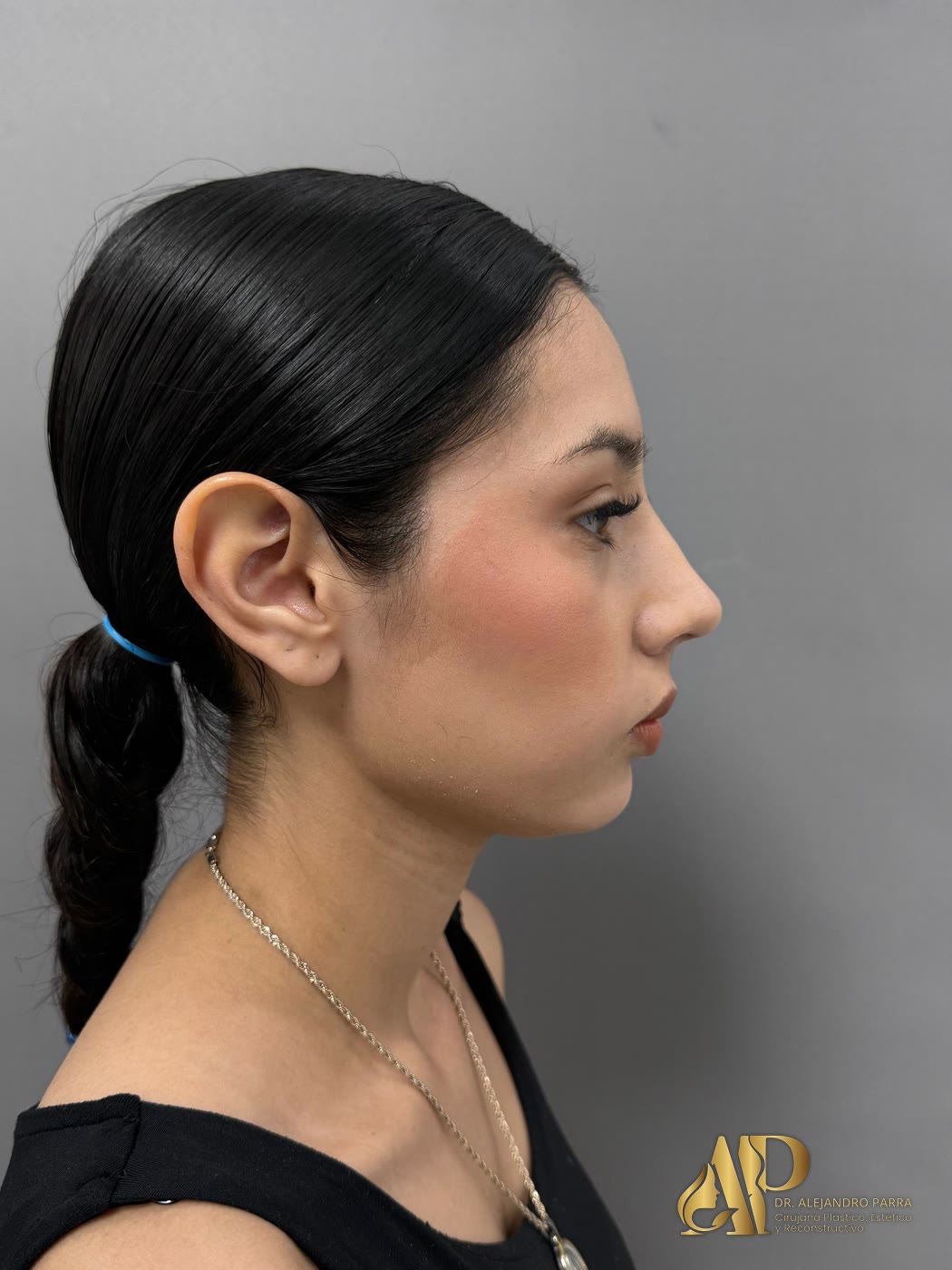 Perfil de una paciente después de una rinoplastia