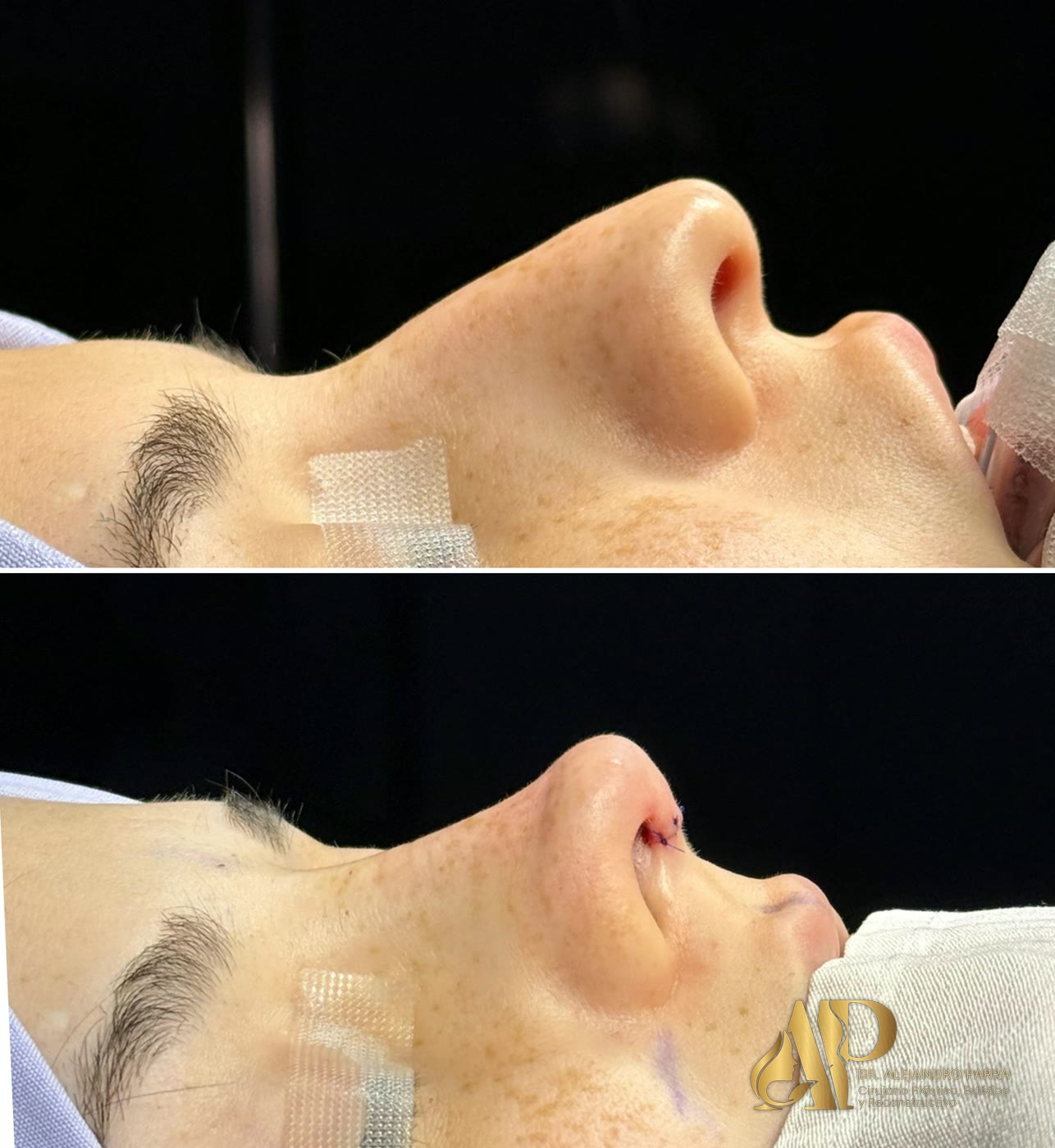 Perfil de una nariz antes de la rinoplastia y al terminar la cirugía, en quirófano