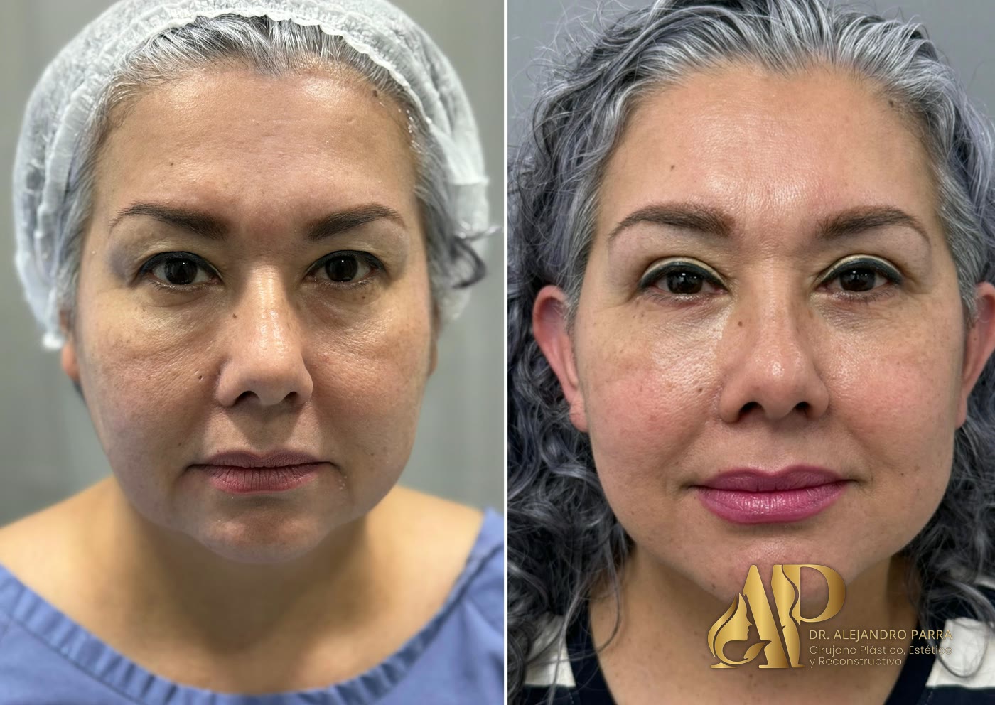 Antes y después de un lifting facial y de cuello, de frente